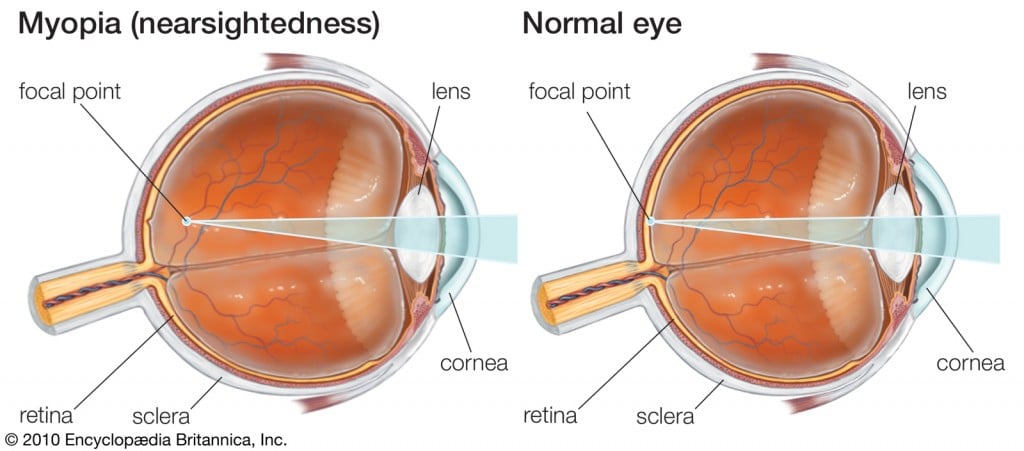 what is myopia